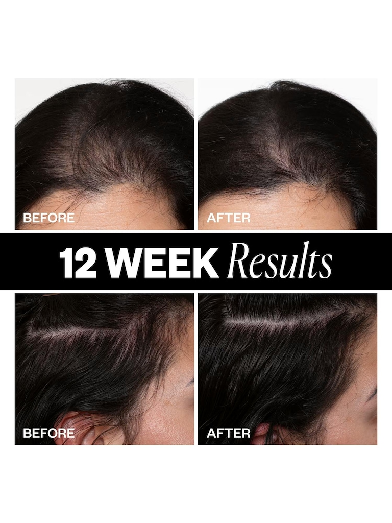 IGK Sponsored High Density Scalp Treatment